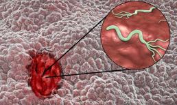 Xin nhắc lại: Sau khi nhiễm vi khuẩn Helicobacter pylori sẽ có 5 biểu hiện, cho thấy bạn sắp bị bệnh dạ dày