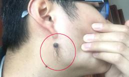 Tại sao trên nốt ruồi lại mọc lông và có nên nhổ lông trên nốt ruồi không?