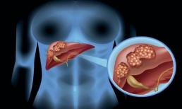 Người có lá gan tốt sẽ không có 3 dấu hiệu này trên bàn tay, hãy so sánh để kiểm tra sức khỏe của bạn