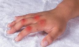 Để thuyên giảm bệnh gút, liệu pháp dinh dưỡng là chìa khóa, và phải hiểu nguyên tắc “2 cao 3 thấp”