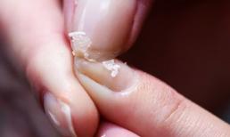 Ung thư gan giai đoạn đầu không đau, không ngứa, trên tay có 3 'dấu hiệu' là gan đang kêu cứu 