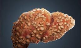 'Loại rau này' được mệnh danh là “Vua hại gan”, hại hơn cả uống rượu, nhưng nhiều người vẫn mua về ăn