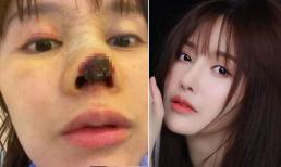 Bất ngờ với nhan sắc hiện tại của nữ diễn viên xinh đẹp từng bị hoại tử mũi do phẫu thuật thẩm mỹ hỏng