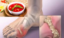 Người bệnh gút (gout) có ăn nội tạng động vật, tiết canh được không? Nhiều người đoán sai sự thật