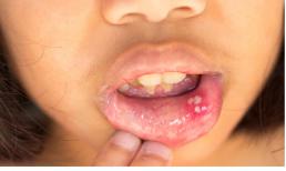 Một phụ nữ bị loét miệng lặp đi lặp lại được chẩn đoán là ung thư lưỡi! Bác sĩ: Hãy tìm bác sĩ sớm sau thời gian này...