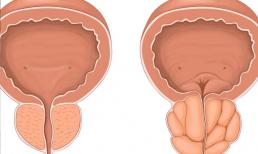 Một hành vi trong đời sống vợ chồng làm tổn thương tuyến tiền liệt của đàn ông, vì vậy đàn ông không còn vui vẻ trong chuyện ấy nữa 