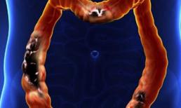 Bác sĩ cho biết: 4 loại thực phẩm này có thể làm tăng nguy cơ ung thư ruột, tốt nhất bạn nên tránh xa