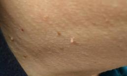 Trên cơ thể bạn có xuất hiện hai loại “mụn nhỏ” này, đừng chỉ nghĩ là dị ứng, có thể virus HPV đã xuất hiện trong cơ thể bạn