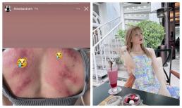 Sau loạt ồn ào với Sơn Tùng và Hải Tú, Thiều Bảo Trâm đổ bệnh