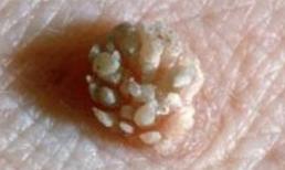 Một phụ nữ 28 tuổi bị phát hiện dương tính với HPV khiến chồng xa lánh!  Bác sĩ: Thực hiện 3 điều có thể chuyển thành âm tính 