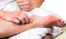 Nhắc lại: Khi bạn ngủ đêm mà cơ thể có 3 biểu hiện thì có thể là axit uric đã “vượt chuẩn”