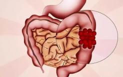 Polyp đại trực tràng phần lớn là do những nguyên nhân này, đừng làm những hành vi 'gây họa' nữa 