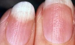 Các đường thẳng đứng và các vết rỗ nhỏ trên móng tay là gì? Có 5 lý do giải thích cho các vết rỗ nhỏ dày đặc