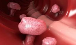 Polyp ruột bắt đầu trở thành ung thư, trong phân sẽ có 4 dấu hiệu, nếu bạn có cả 4 dấu hiệu thì đã đến lúc đi khám sức khỏe