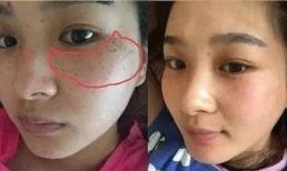 Phụ nữ sợ nhất những đốm mụn trên khuôn mặt? 5 bước nhỏ này có thể giúp da mặt bạn không còn đốm mụn! 