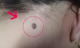 Bác sĩ nhắc nhở: Nếu nốt ruồi mọc ở 4 bộ phận này, hãy để ý kỹ và đi kiểm tra càng sớm càng tốt 