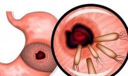 Sau khi xác định nhiễm Helicobacter pylori, hãy ghi nhớ: “hai bớt, ba yêu cầu”, dạ dày sẽ ngày càng tốt hơn