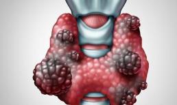 “Ung thư tuyến giáp” tìm đến cửa, nếu có 3 biểu hiện này, tốt nhất bạn không nên bỏ qua