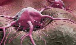 90% ung thư dạ dày được phát hiện ở giai đoạn giữa và cuối! Có 4 biểu hiện này sau bữa ăn, hãy đi nội soi dạ dày