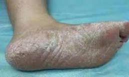 Vào mùa đông, gót chân bị khô và bong vảy, thường nứt nẻ, đau nhức, đây không phải là thiếu nước, có thể là nấm da chân! 