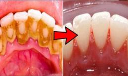Cao răng quá nhiều khó làm sạch? Hướng dẫn bạn '5 mẹo' không cần đến nha sĩ vẫn có thể đánh sạch cao răng dễ dàng