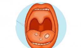 Đừng bỏ qua bệnh viêm loét miệng! Nó sẽ phát triển thành ung thư miệng, và các tín hiệu từ khoang miệng cần phải cảnh giác