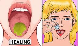 Ăn lẩu, nướng nhiều bị bỏng rát lưỡi và 10 cách chữa lành cấp tốc nhanh chóng, cực kì hiệu quả