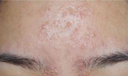 6 vị trí “nổi mụn” này thực chất đồng nghĩa với việc cơ thể đang “gửi lời cảnh báo” đến bạn đấy! 