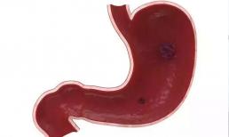 Cơ thể xuất hiện 4 dấu hiệu bất thường liên tiếp hoặc ung thư dạ dày đã đến cửa, hãy kiểm tra kịp thời và đừng bỏ qua 