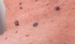 Nhắc nhở: Nốt ruồi ở hai bộ phận dễ bị ung thư nhất, hãy xem bạn có không?