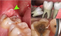  Có nên “nhổ răng khôn” không? Xin đừng hoảng sợ! Bài viết này sẽ cung cấp cho bạn những hiểu biết đầy đủ về răng khôn!