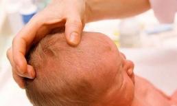 Thóp của trẻ được ví như 'cánh cửa của sự sống', nếu xảy ra những hiện tượng này, cha mẹ không nên trì hoãn mà hãy đến bệnh viện để thăm khám kịp thời