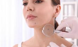 5 nốt ruồi tốt, về già con cháu giàu sang