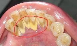 Mảng bám vàng trên răng, xấu xí và nặng mùi! Ba cách để giúp răng của bạn trắng hơn