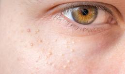 Những nốt mụn nhỏ màu trắng xuất hiện trên da là gì và cách xử lý chúng?