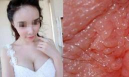 Lưu ý! Một cô gái 22 tuổi chưa từng có bạn trai, nhưng lại mắc bệnh 'hoa liễu'! Bài học cho rất nhiều phụ nữ, đặc biệt ngành ngân hàng