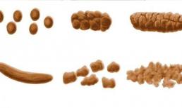 Sau khi đi vệ sinh, hãy “nán lại 1 giây để quan sát phân”, việc xuất hiện những hình thù, màu sắc này đồng nghĩa với việc bạn cần đi khám ngay