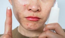 5 cách để điều trị mụn, khắc phục tình trạng mụn nhỏ tạo thành sẹo