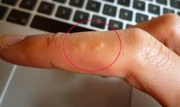 Gần đây, xuất hiện những “mụn nước nhỏ trong suốt” nổi lên trên tay ngày càng ngứa ngáy khi gãi, chỉ cần bạn làm như vậy là khỏi hoàn toàn nhé