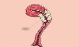 Phụ nữ khi đi vệ sinh hãy để ý nếu có 3 dấu hiệu này thì có lẽ tử cung đang 'cầu cứu'