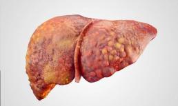 Tại sao bệnh xơ gan thường xuyên xảy ra, bác sĩ nói thẳng: 1 loại bộ đồ ăn là 'thủ phạm', đọc xong nên vứt bỏ