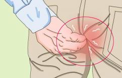 Tại sao nhiều người lại mọc 'lông hậu môn'? Có nên cạo bỏ không? 