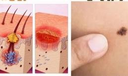 'Nốt ruồi đen trên cơ thể' không phải là bệnh ngoài da! Có 5 loại “bất thường” ở da cần cảnh giác sự tấn công của ung thư, phát hiện sớm và điều trị sớm là điều “then chốt”