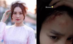 Ninh Dương Lan Ngọc khiến fans hoang mang tột độ khi bị chấn thương vùng đầu, riêng 1 chi tiết gây lo lắng hơn bao giờ hết