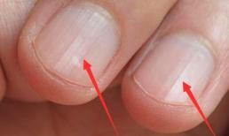 Trên móng tay có những 'đường kẻ dọc', phần lớn chỉ ra 4 vấn đề, có thể bạn phải chú ý hơn