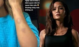 H'Hen Niê 'khoe' vết bầm tím chi chít trên cơ thể khi quay dự án phim mới