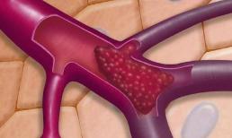 Mạch máu bị tắc, bộ phận này có thể sẽ báo cho bạn, đừng ngu ngơ mà bỏ qua, hãy xem!