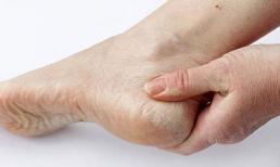 Gan có tốt hay không là do bàn chân 'biết trước', nếu bàn chân gửi 4 'tín hiệu' này, đừng bất cẩn 