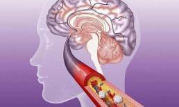 Một người đàn ông 33 tuổi đột ngột bị nhồi máu não. Chuyên gia: Hai thói quen này 'không thay đổi', những thói quen khác đều vô nghĩa!