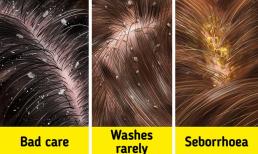 Gàu là gì và làm thế nào để thoát khỏi nó?